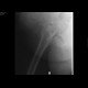 Acetabular fracture, posterior dislocation of the femoral head, dashboad injury: X-ray - Plain radiograph